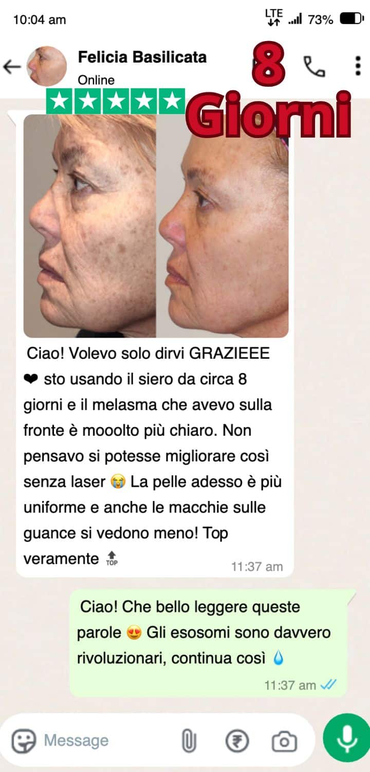 Prima e dopo trattamento melasma, pelle più chiara e uniforme.